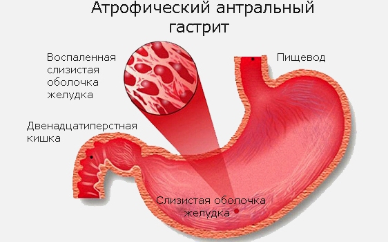 Можно ли спиртное при гастрите