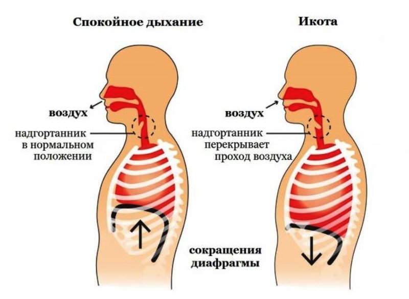 Как остановить икоту после алкоголя