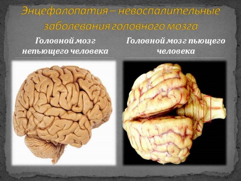 Лечение алкогольной энцефалопатии