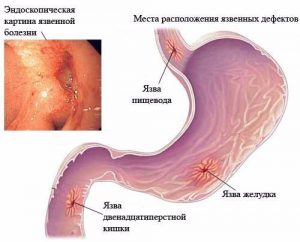 Алкоголь при язвенной болезни