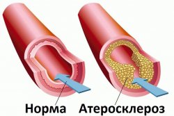 Делаем настойку на сосновых шишках